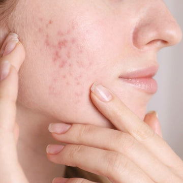 Primer plano de la cara de una mujer con rosacea